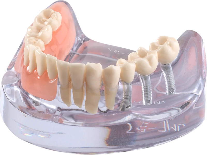 Implantatmodell UK mit Prothesen iP12-SB11  Stück