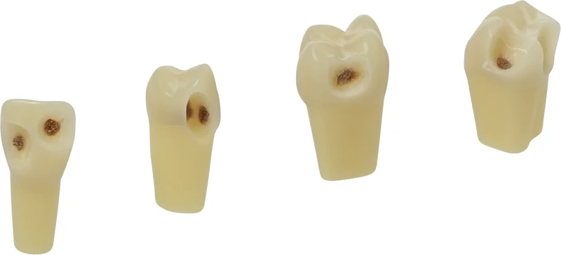 Kariesmodellzahn Zweischicht   Stück  Nr. 25