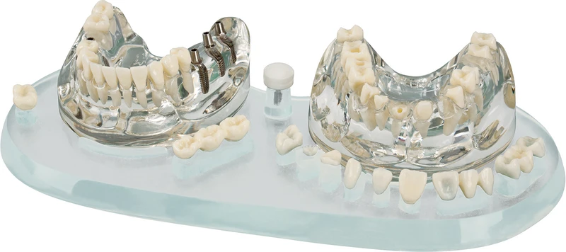 Studienmodell Demo Implant C&B  Stück