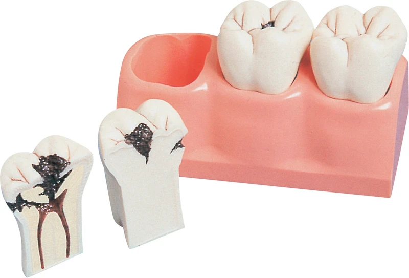 Kariesmodell P13-TR7  Stück