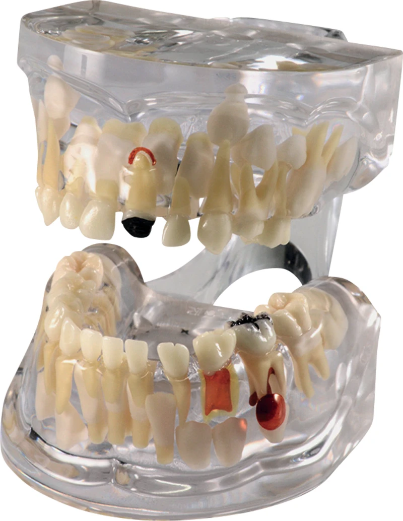 Pathologisches Wachstumsmodell mit Karies P12P-100R  Stück