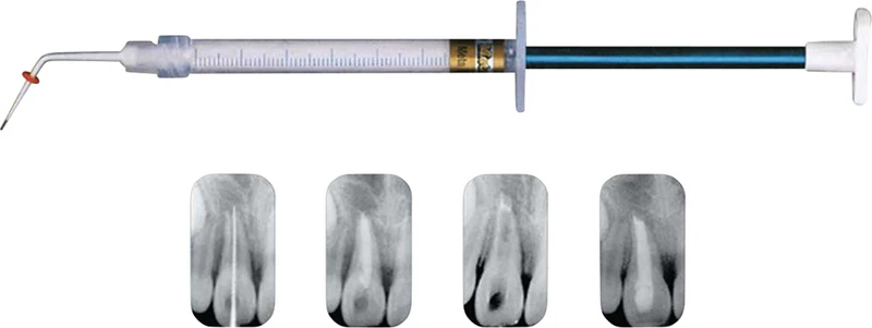 Metapaste  Spritze  2,2 g
