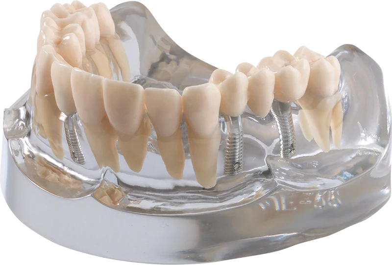 Implantatmodell OK mit Krone + Brücke iP12-SB10  Stück