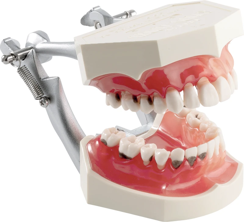 Parodontiemodell mit Karies P2D-001  Stück