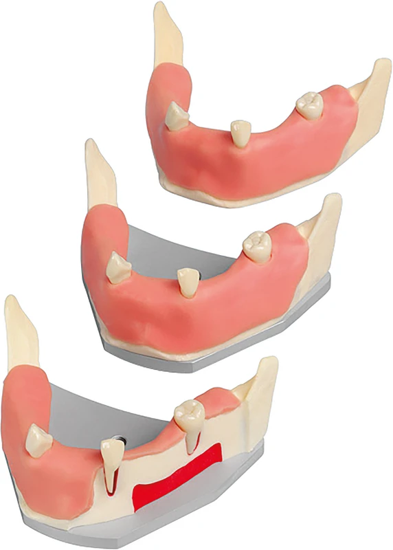 Implantat-Unterkiefer  Stück