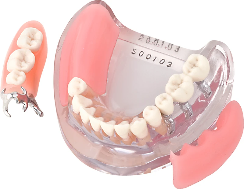 Implantmodell UK mit Krone + Prothese iP9-3100  Stück