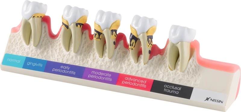 Demonstrationsmodell Parodontose-Stadien P23-PD1  Stück