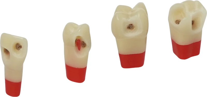 Kariesmodellzahn Mehrschicht   Stück  Nr. 26