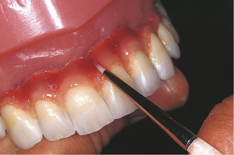 GC GRADIA® gum shades   Spritze  2,4 ml Paste gum modifier GM32